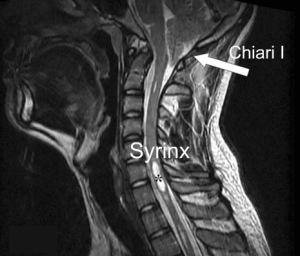 MRI T2 sagittaal met Chiari en cervicale syringomyelie