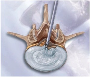 Endoscoop via interlaminaire benadering met resectie herni