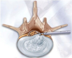 Endoscoop via transforaminale benadering met resectie hernia