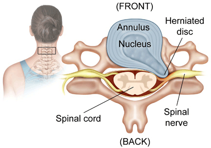 Cervicale hernia