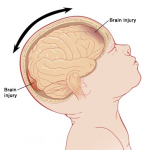 Mechanisme van hersenbeschadiging bij een Shaken Baby Syndrome: de hersenen botsen tegen de voor -en achterkant van de schedel