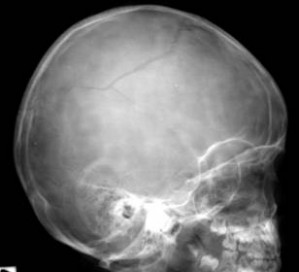 RX schedel met fraktuur van voor naar achter (frontopariëtaal)