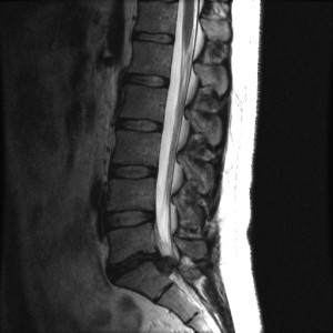 T2 MRI: grote afdalende hernia L5-S1