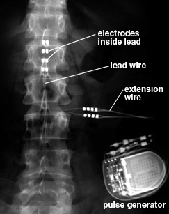 Dorsal Cord Stimulation: 8-polige electrode via beperkte laminectomie op de dorsale zijde van het ruggenmerg geplaatst