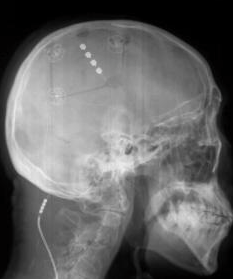 Motorcortexstimulatie: 4-polige electrode via craniotomie ingebracht op de hersenschors