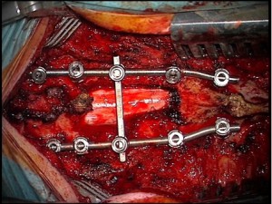 Peroperatieve foto na verwijderen cervicale tumor en na plaatsen osteosynthese