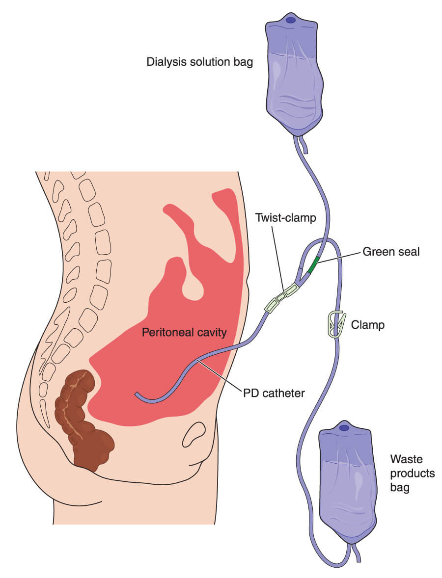 Nierziekten peritoneale dialyse