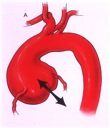 De gedilateerde aortawortel 