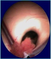 Zicht bij intrede in de laterale ventrikel op het foramen van Monroe, de doorgang naar de derde ventrikel