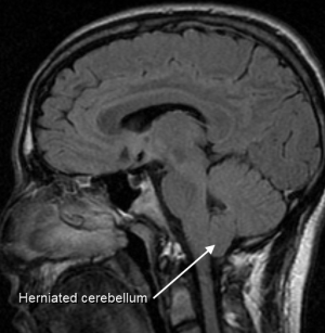 T1 MRI sagittaal met indaling van de kleinhersentonsillen doorheen het achterhoofdsgat