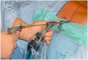 Peroperatieve foto met transforaminaal ingebrachte endoscoop