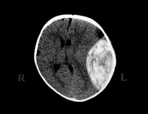 CT schedel bij een kind met en groot epiduraal hematoom (hyperdense witte zone) met verdringen van de hersenen