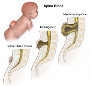 Vormen spina bifida